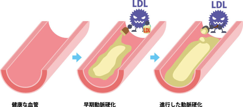 脂質異常症（高LDLコレステロール血症）における食事療法についてのアイキャッチ画像