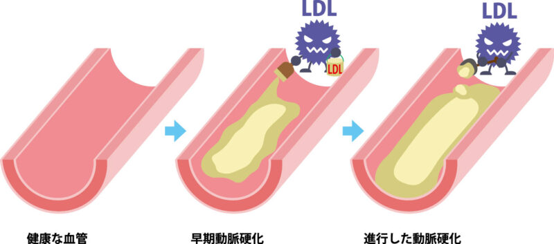 脂質異常症（高LDLコレステロール血症）における食事療法について 